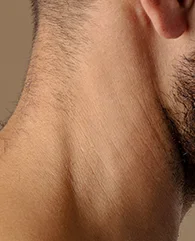 Neck hair removal