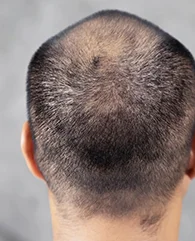 PRP treatment for Post-Surgical Hair Loss
