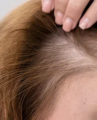 PRP treatment for Telogen Effluvium