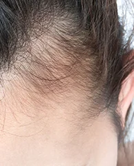 PRP treatment for Traction Alopecia (Mild Cases)