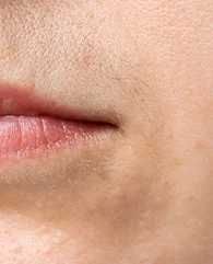 Face (upper lip, chin, sideburns) LHR