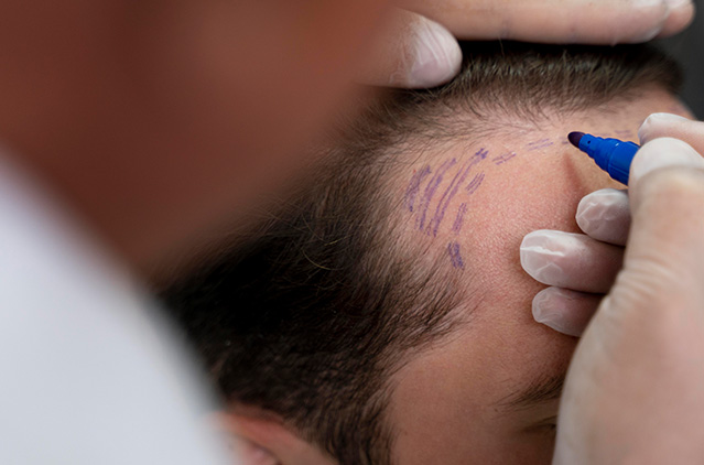 Hair transplant procedure: what you should really know before deciding