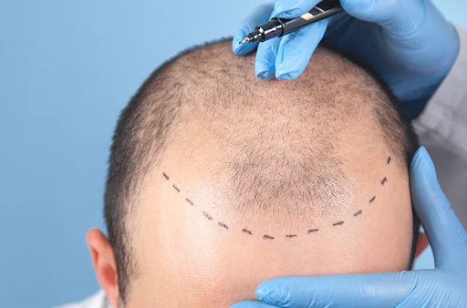 Key Benefits of Hair Transplant for a Fuller Look