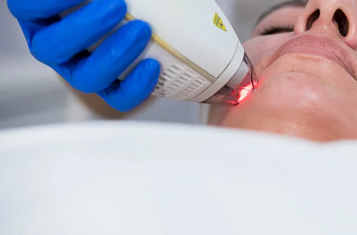 Laser Treatment for Acne Scars Side Effects — What to Know