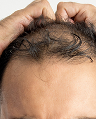 Male Receding temples treatment with qr678