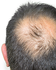 Crown or vertex thinning treatment with qr678
