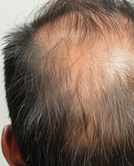 Diffuse hair loss from stress, nutrition, or lifestyle