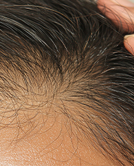 Diffuse thinning across the scalp treatment with qr678