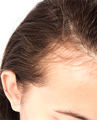 Female pattern hair loss treatment with QR678