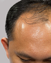 Male Frontal hairline thinning treatment with qr678