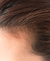 Frontal or temple thinning treatment with QR678