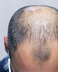 Male Pattern Baldness Treatment with QR678