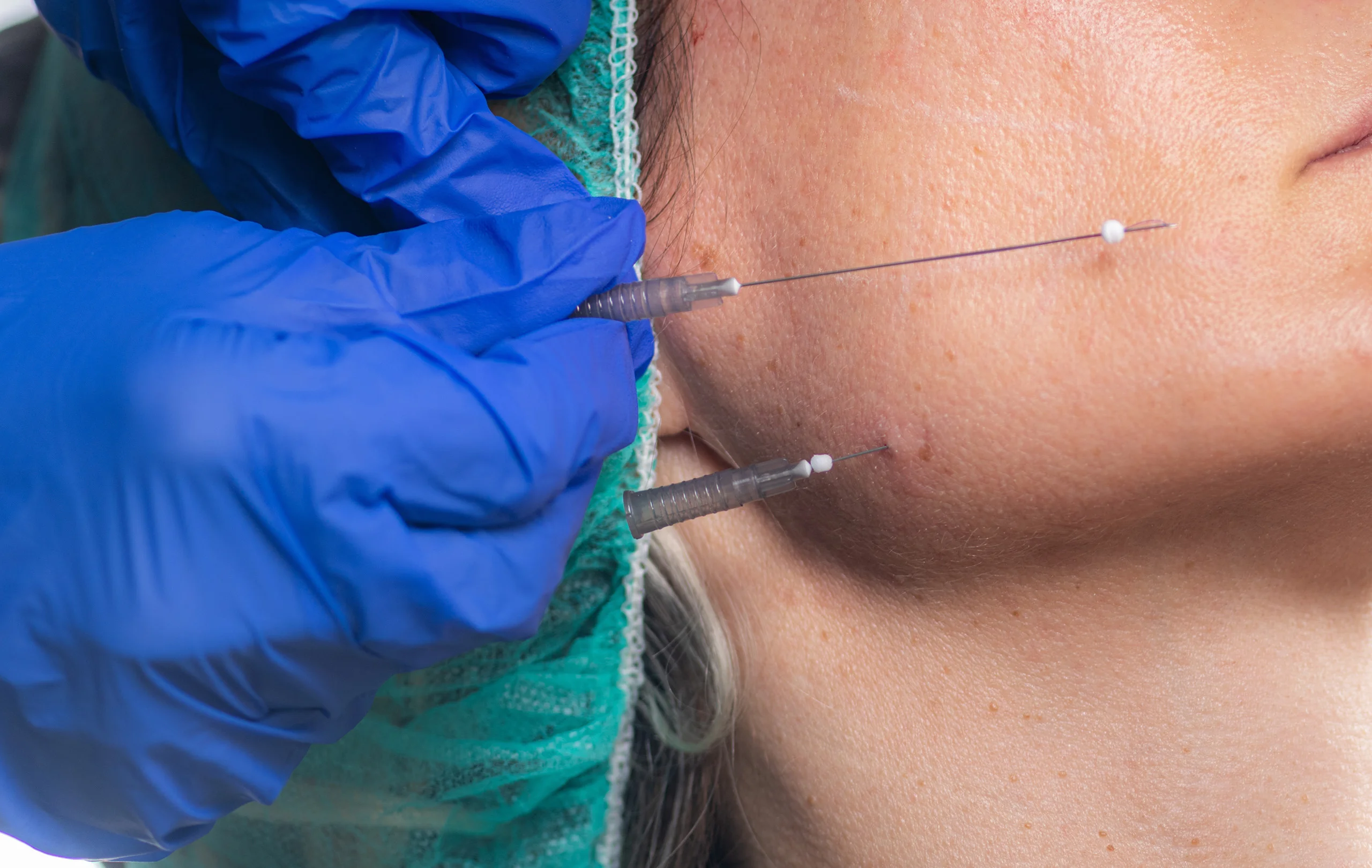 Thread Lift Cost in Mumbai – Are You Paying More than You Should?