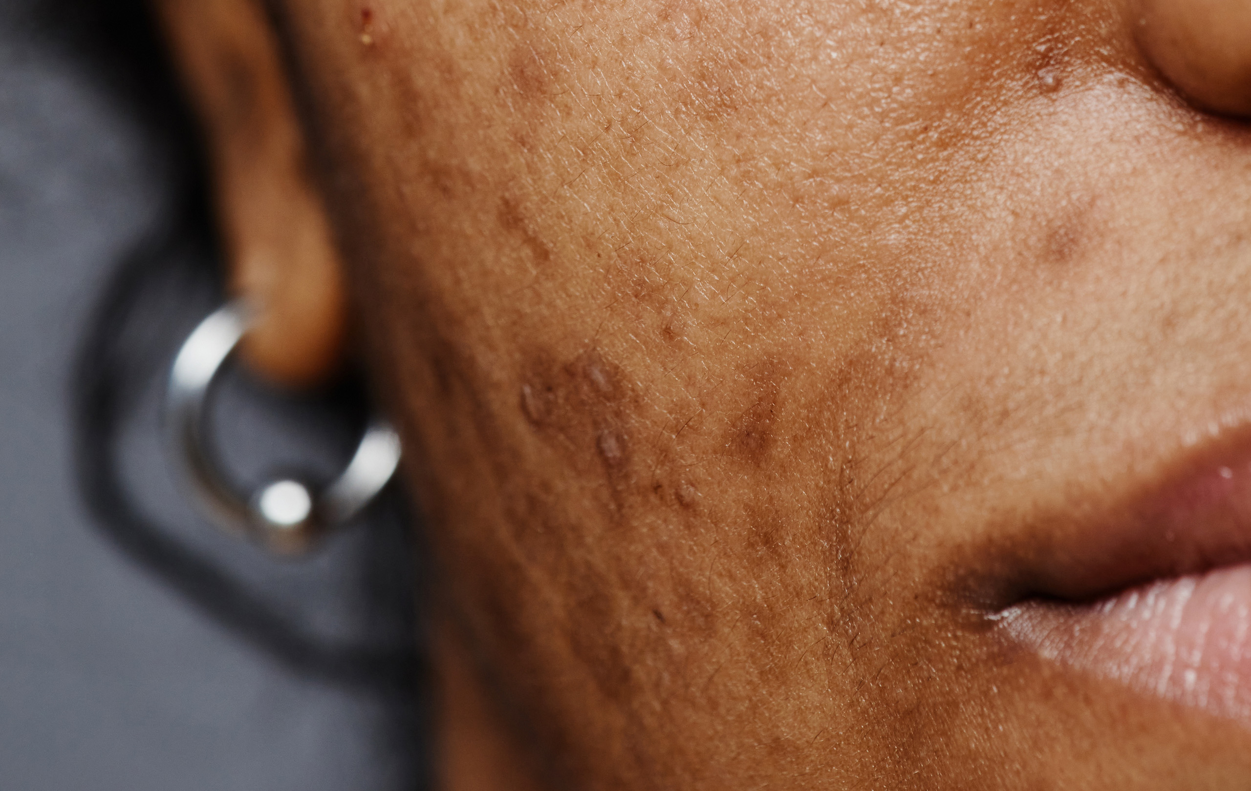 Laser Treatment for Melasma: What Dermatologists Wish You Knew Before Trying it in 2026