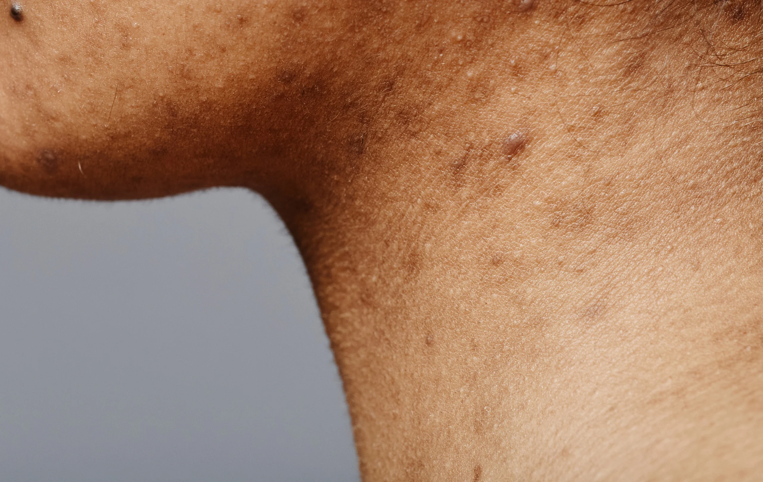 Causes of Neck Pigmentation During Pregnancy and Effective Treatment Methods