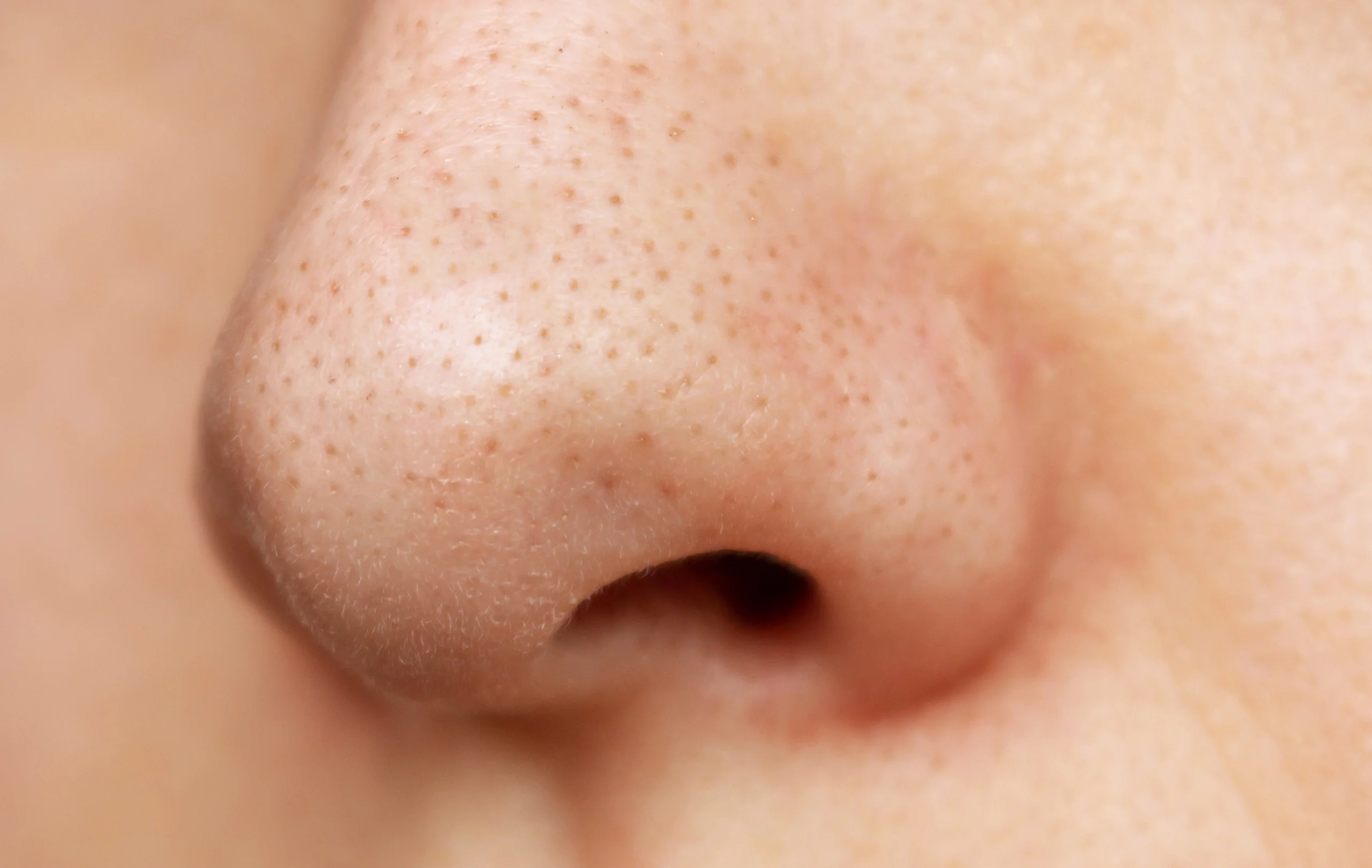 Blackheads vs Whiteheads: What Is the Difference and How to Deal with Them?