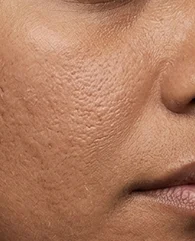 Dullness and rough skin