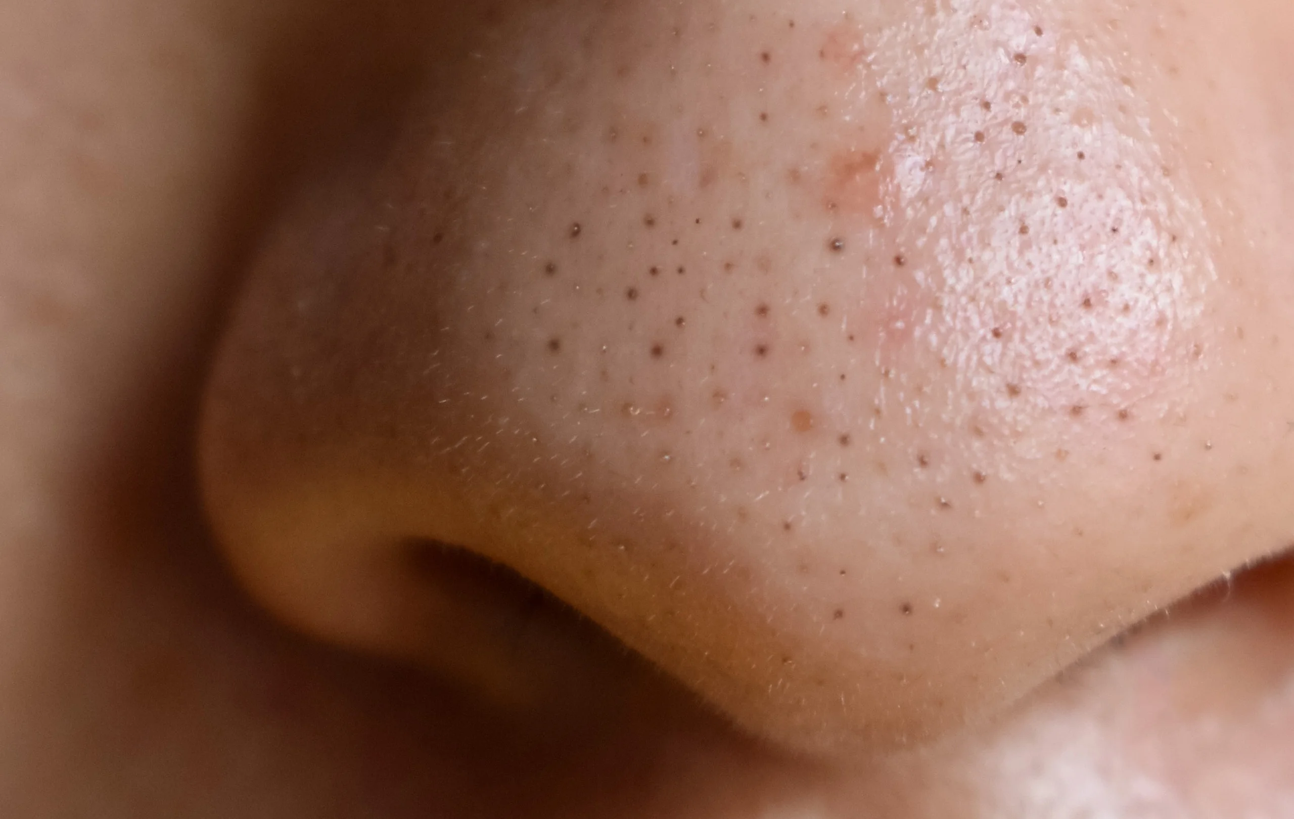 How to Get Rid of Blackheads on Nose: Full Guide