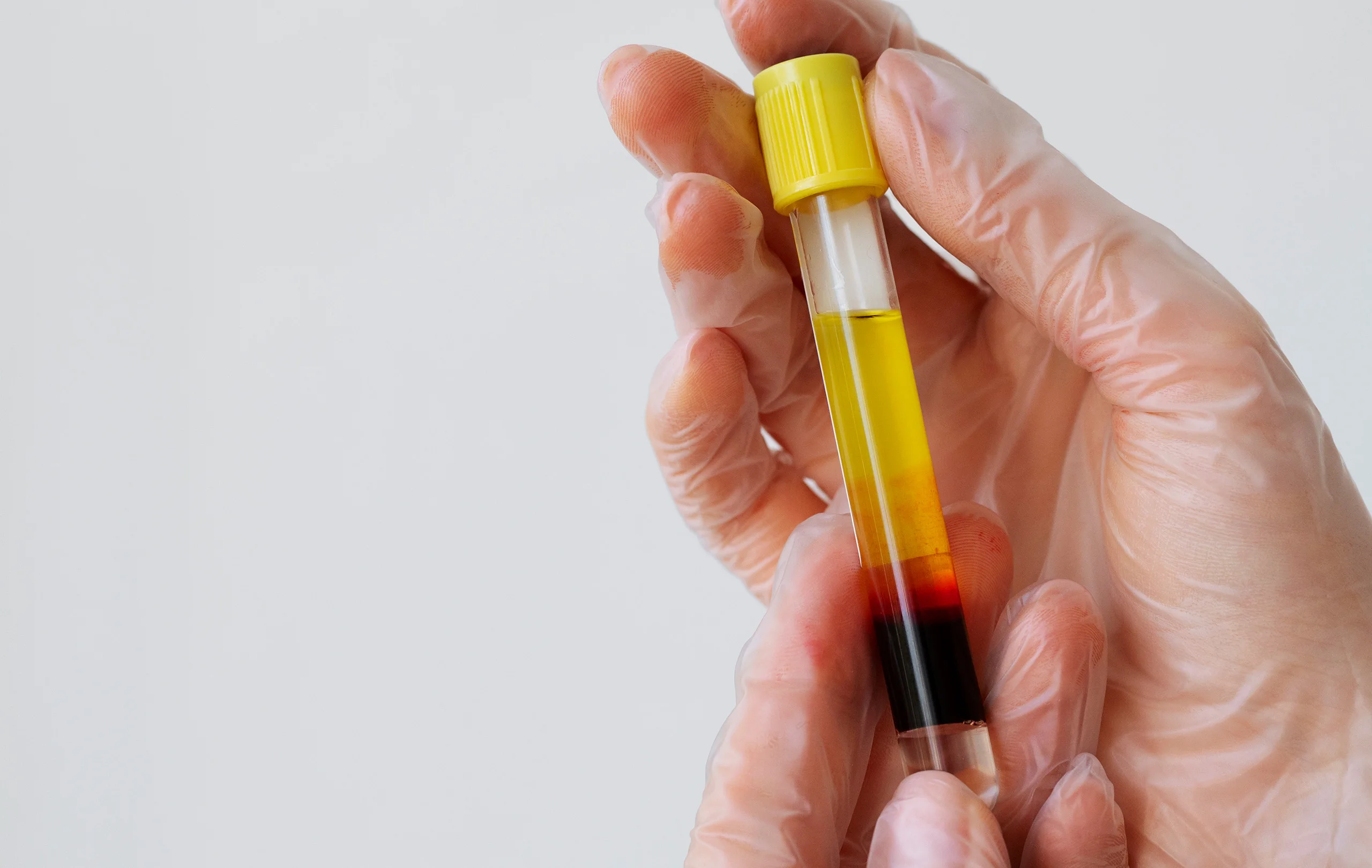 How Much Does PRP Treatment Cost in India in 2026