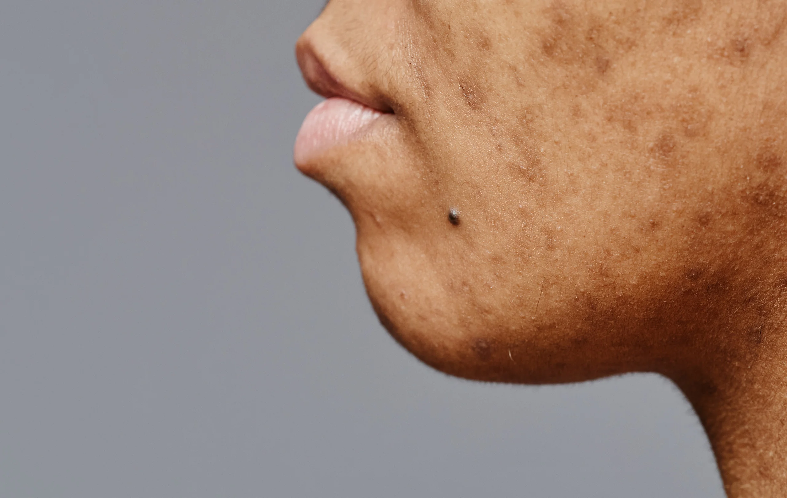 Different Types of Skin Pigmentation: Causes & Treatments