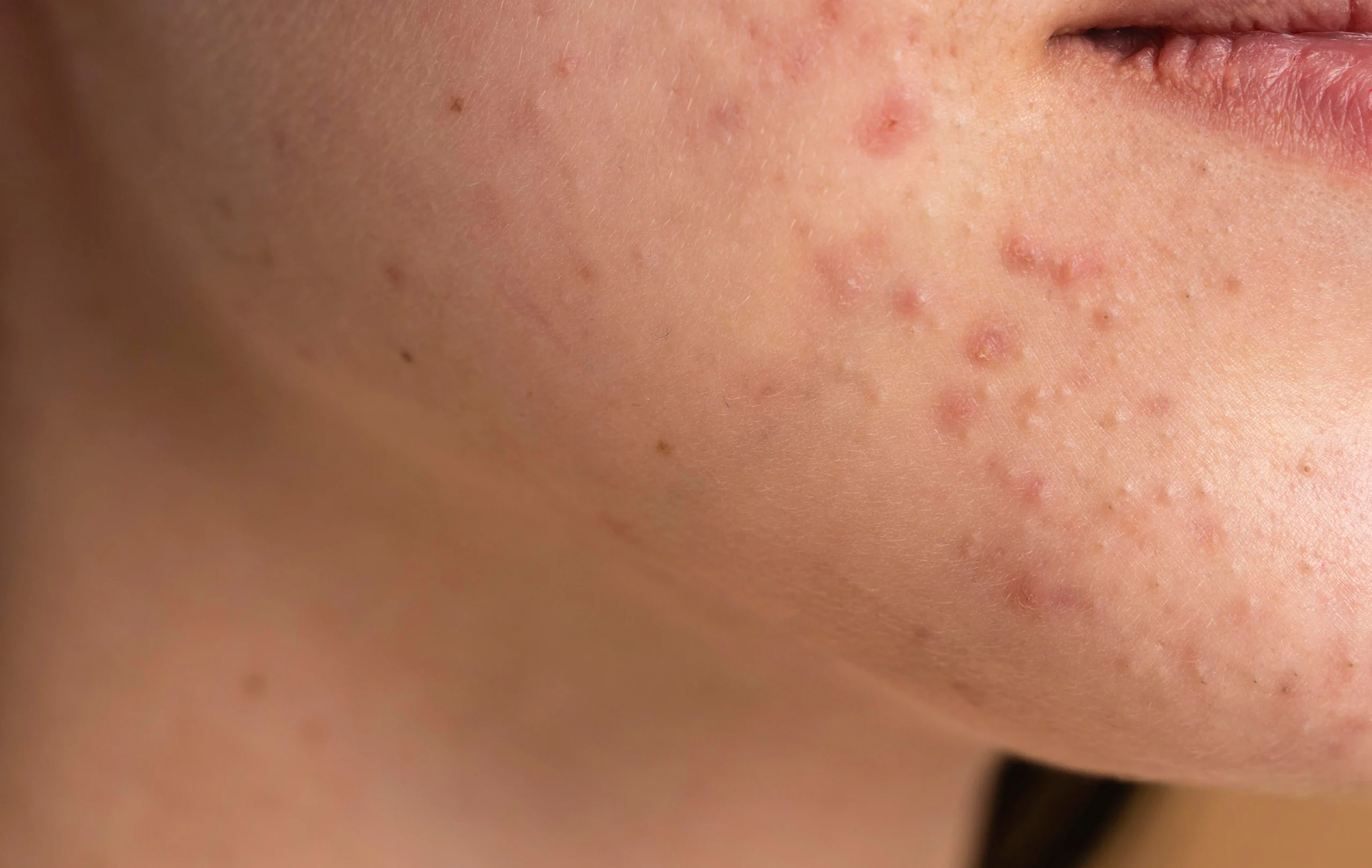 Types of Pimples on the Face